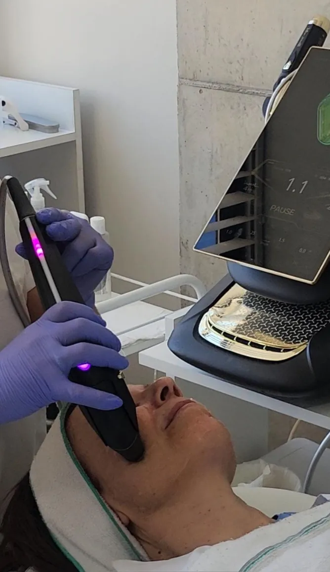 Sesión de HIFU facial con el cabezal sobre el contorno de la mandíbula